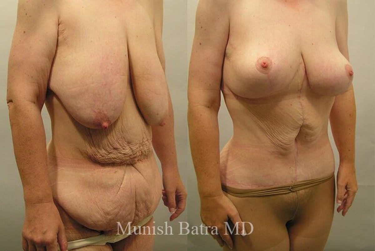 GBRX Abdominoplasty Reconstruction Before & After Gallery - Patient 298799 - Image 1