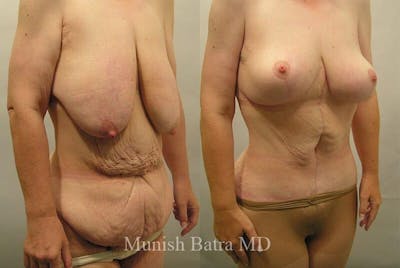 GBRX Abdominoplasty Reconstruction Before & After Gallery - Patient 298799 - Image 1