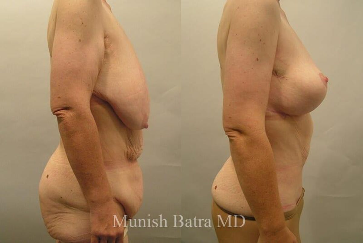 GBRX Abdominoplasty Reconstruction Before & After Gallery - Patient 298799 - Image 2