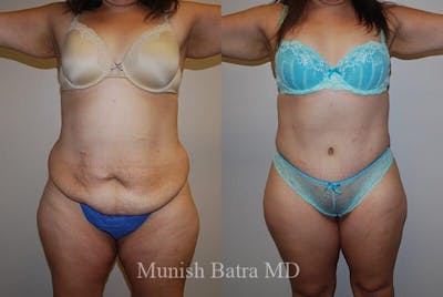 GBRX Abdominoplasty Reconstruction Before & After Gallery - Patient 277225 - Image 1