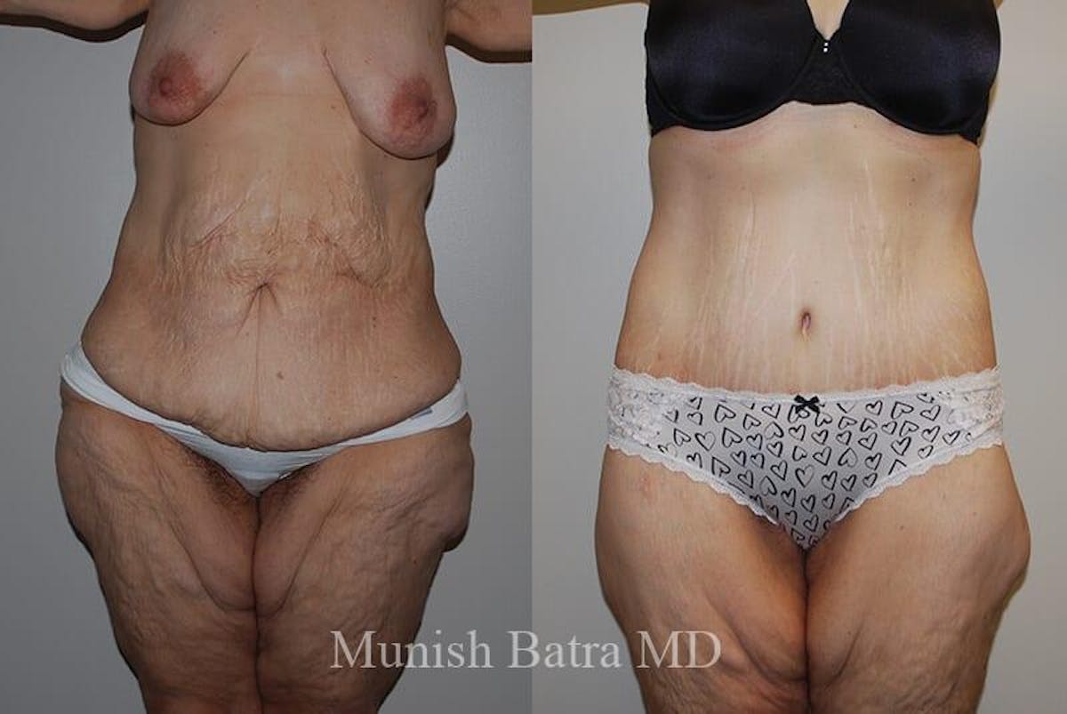 GBRX Abdominoplasty Reconstruction Before & After Gallery - Patient 383531 - Image 1