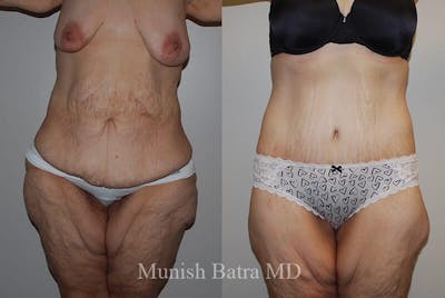 GBRX Abdominoplasty Reconstruction Before & After Gallery - Patient 383531 - Image 1