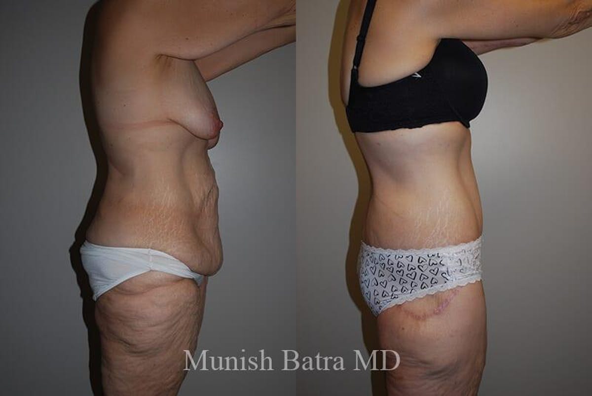 GBRX Abdominoplasty Reconstruction Before & After Gallery - Patient 383531 - Image 2