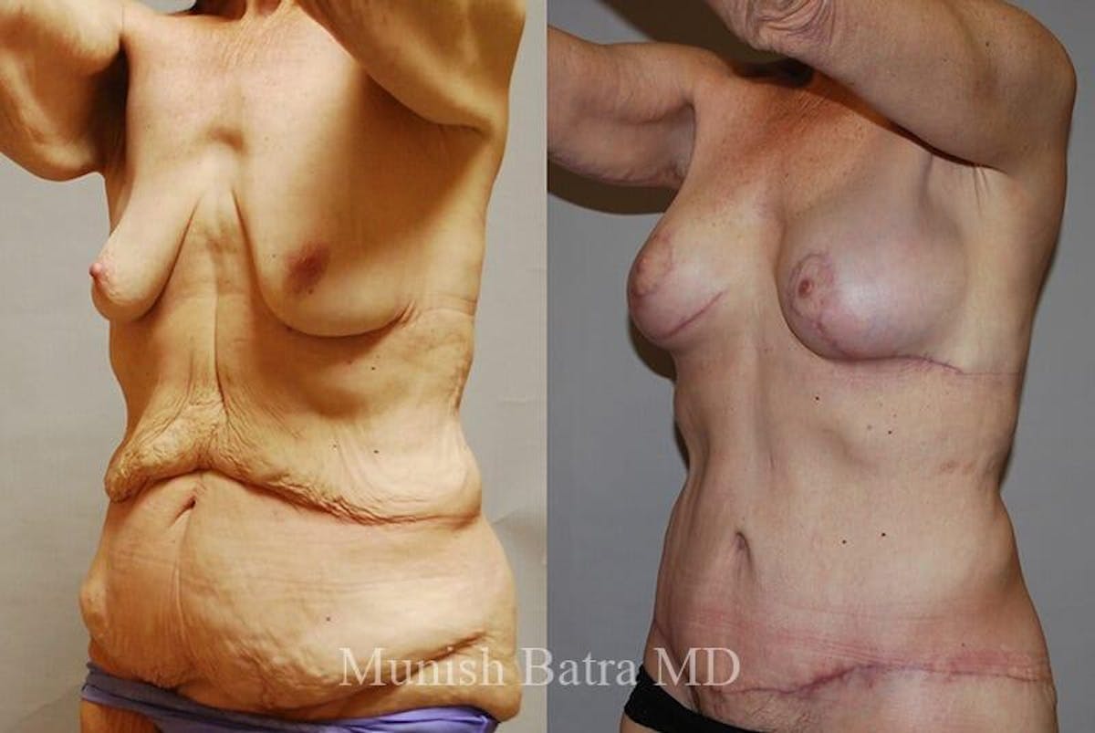 GBRX Abdominoplasty Reconstruction Before & After Gallery - Patient 367070 - Image 1