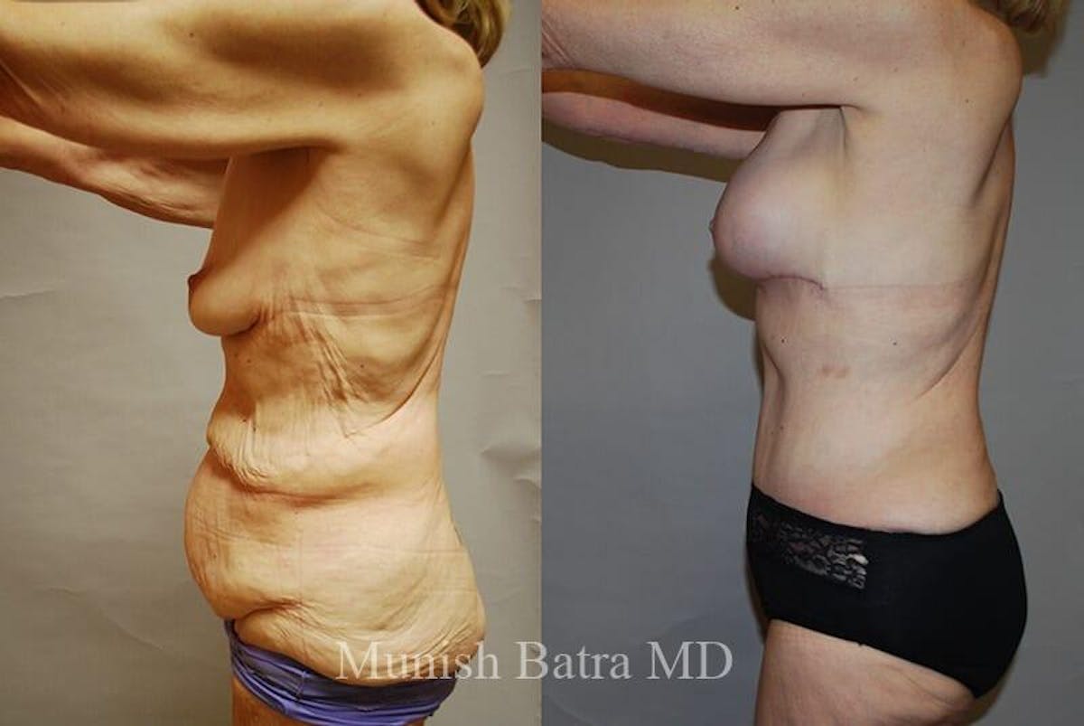 GBRX Abdominoplasty Reconstruction Before & After Gallery - Patient 367070 - Image 2