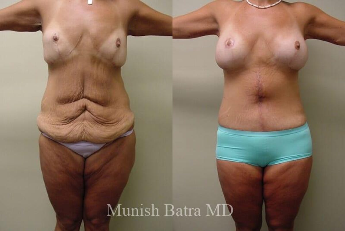 GBRX Abdominoplasty Reconstruction Before & After Gallery - Patient 179416 - Image 1