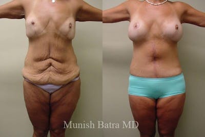 GBRX Abdominoplasty Reconstruction Before & After Gallery - Patient 179416 - Image 1