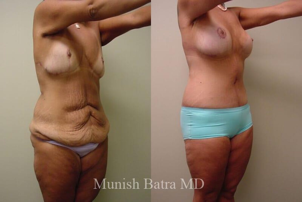 GBRX Abdominoplasty Reconstruction Before & After Gallery - Patient 179416 - Image 2