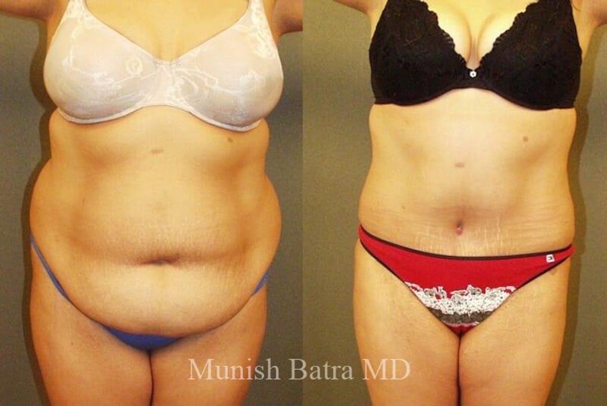 GBRX Abdominoplasty Reconstruction Before & After Gallery - Patient 338086 - Image 1