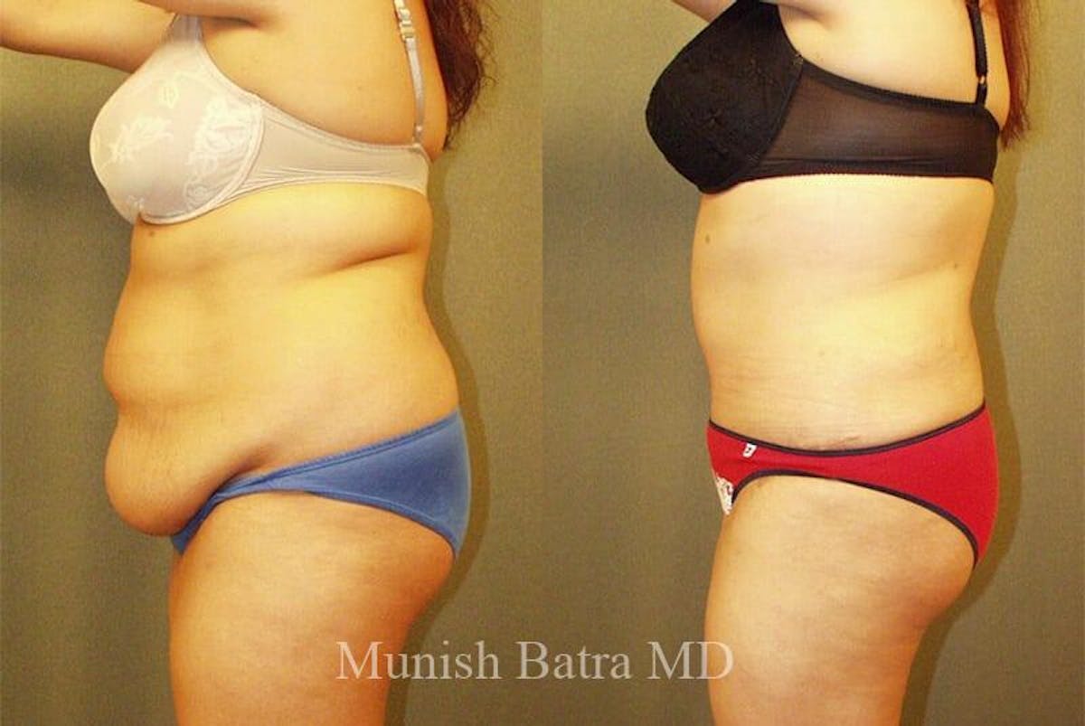 GBRX Abdominoplasty Reconstruction Before & After Gallery - Patient 338086 - Image 2