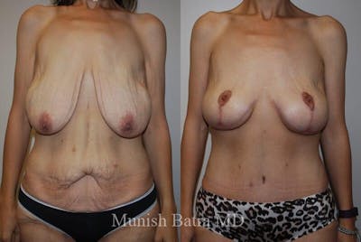 GBRX Abdominoplasty Reconstruction Before & After Gallery - Patient 110228 - Image 1