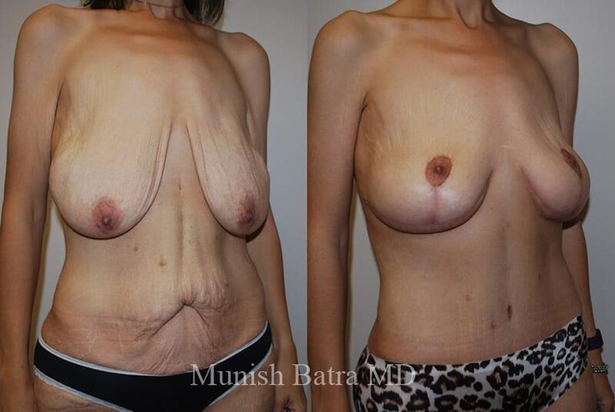 GBRX Abdominoplasty Reconstruction Before & After Gallery - Patient 110228 - Image 2