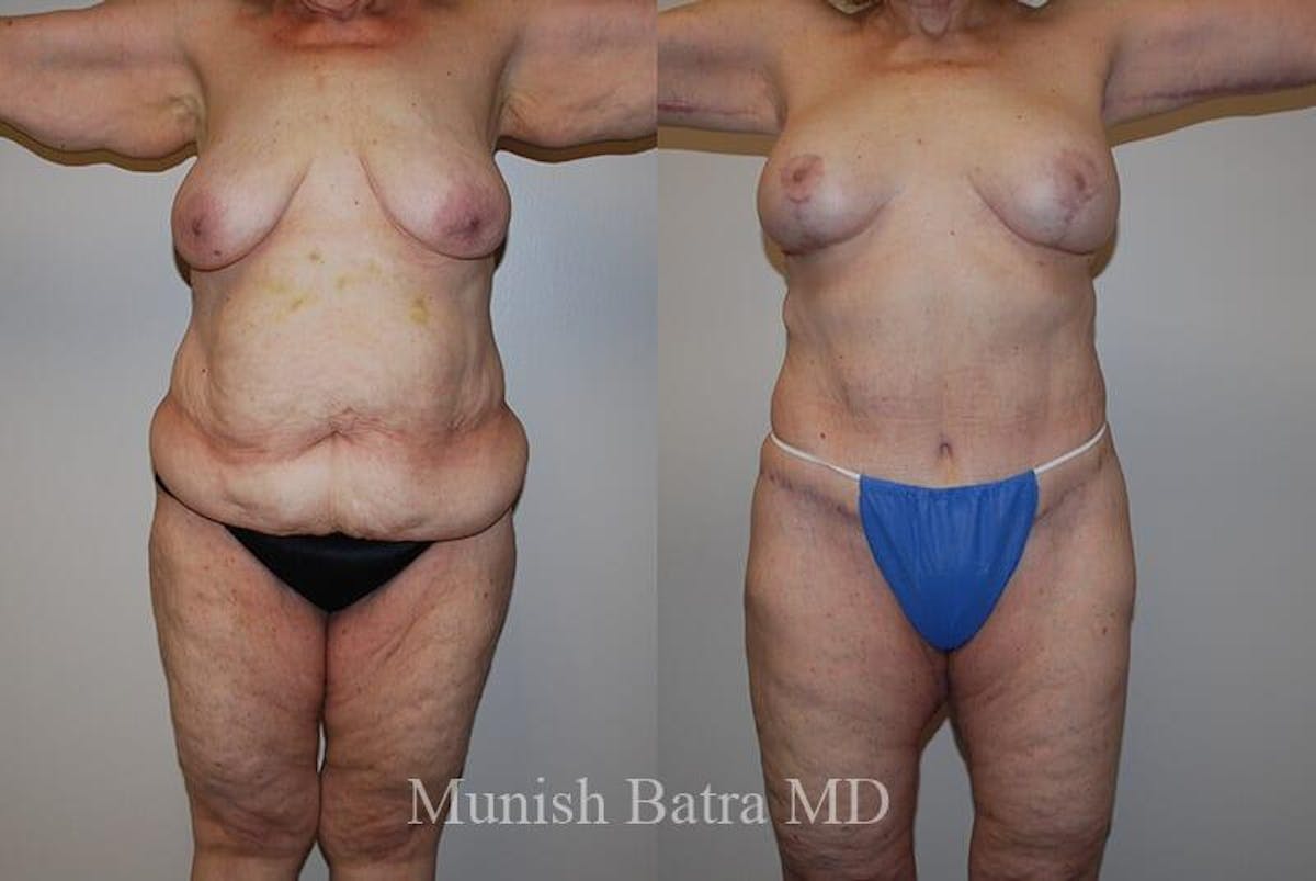 GBRX Abdominoplasty Reconstruction Before & After Gallery - Patient 365547 - Image 1