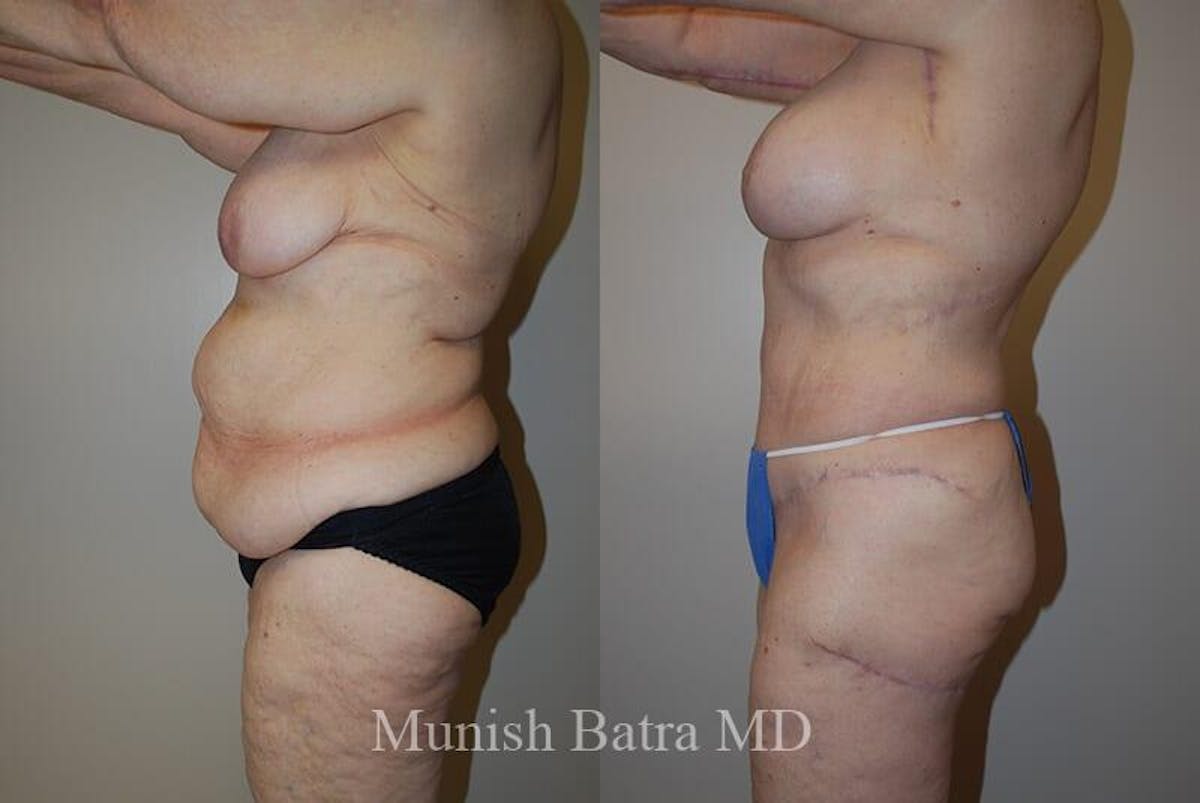 GBRX Abdominoplasty Reconstruction Before & After Gallery - Patient 365547 - Image 2