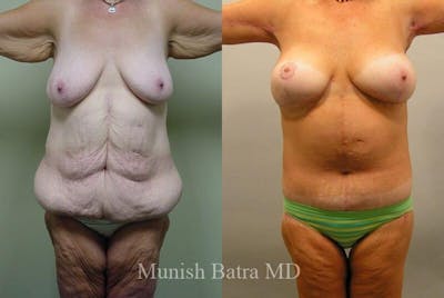 GBRX Abdominoplasty Reconstruction Before & After Gallery - Patient 307109 - Image 1