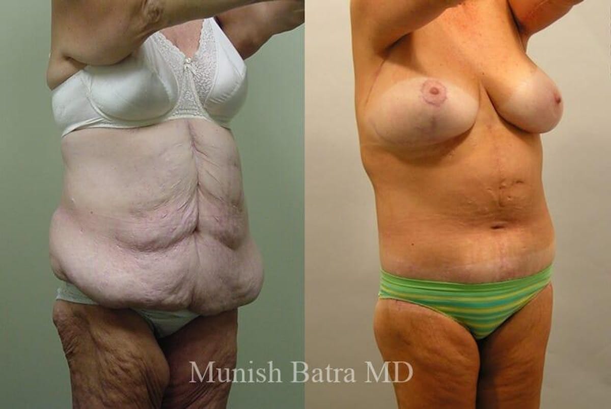 GBRX Abdominoplasty Reconstruction Before & After Gallery - Patient 307109 - Image 2