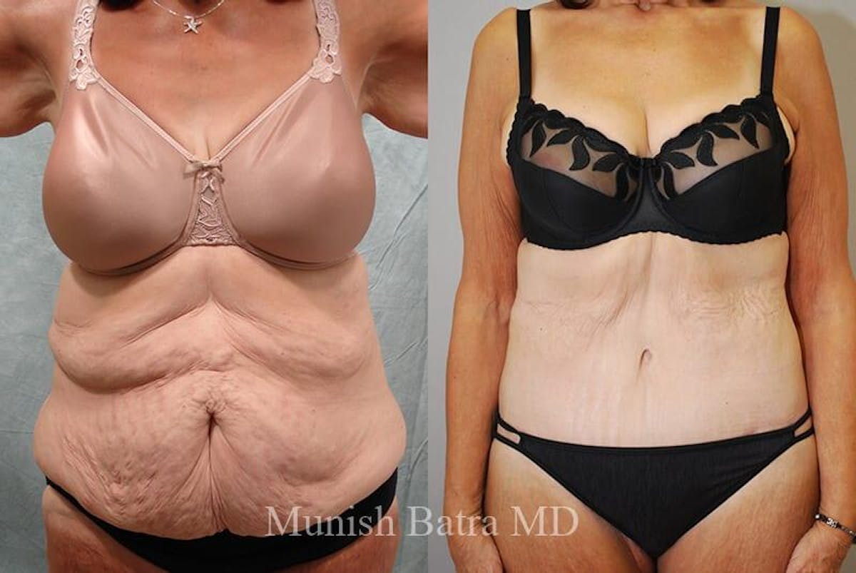 GBRX Abdominoplasty Reconstruction Before & After Gallery - Patient 934481 - Image 1