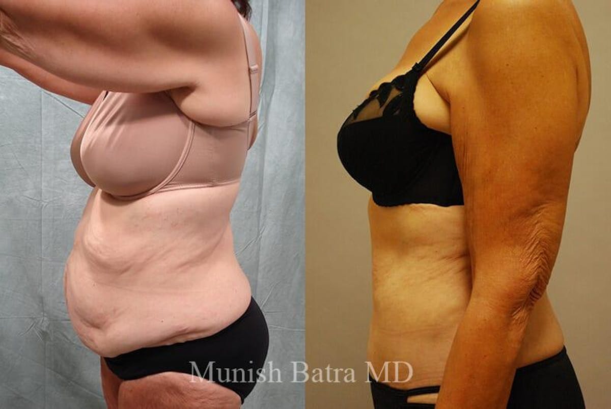GBRX Abdominoplasty Reconstruction Before & After Gallery - Patient 934481 - Image 2