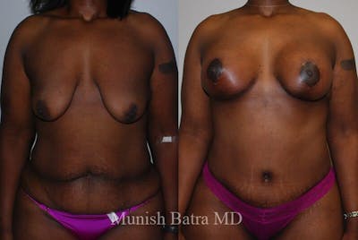 GBRX Abdominoplasty Reconstruction Before & After Gallery - Patient 141207 - Image 1