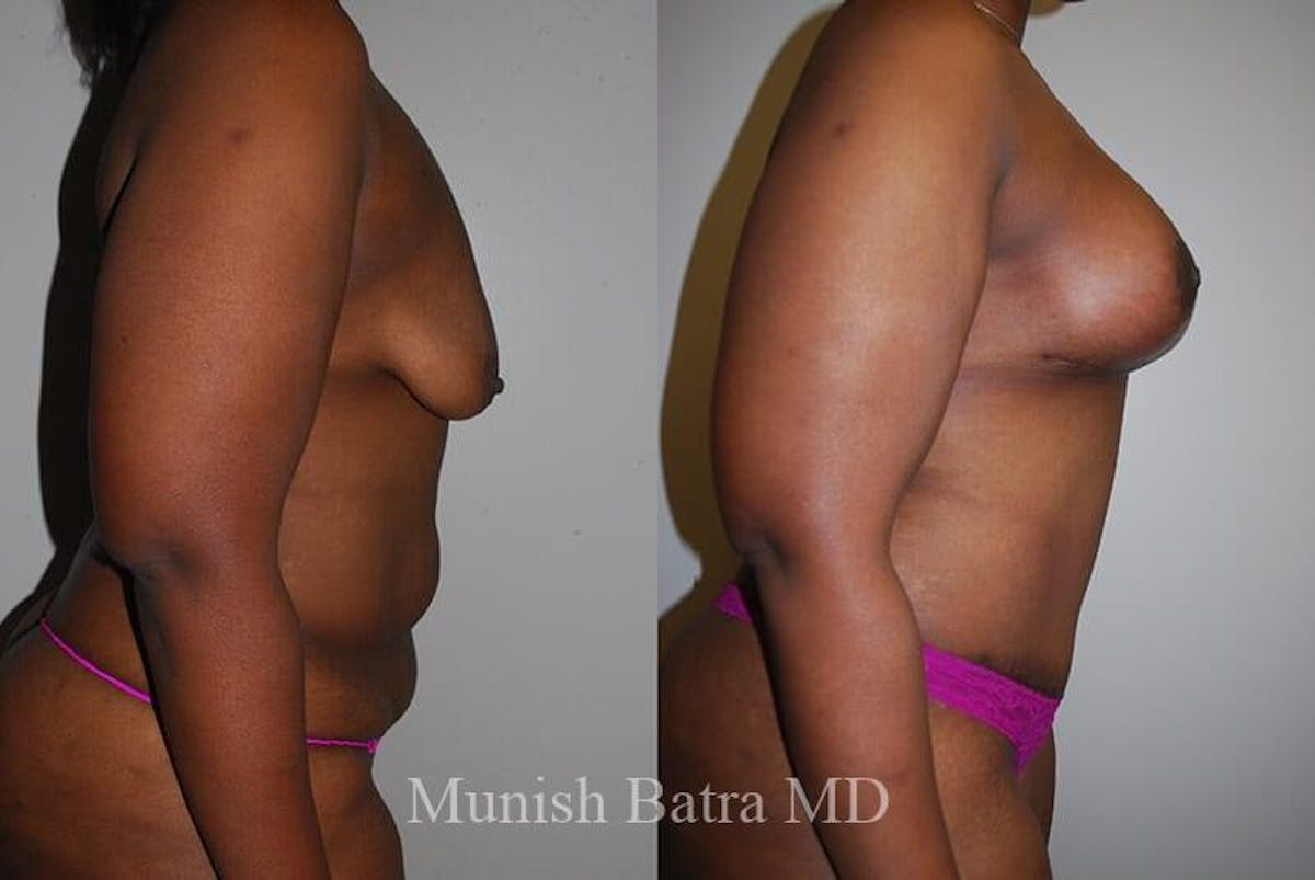 GBRX Abdominoplasty Reconstruction Before & After Gallery - Patient 141207 - Image 2