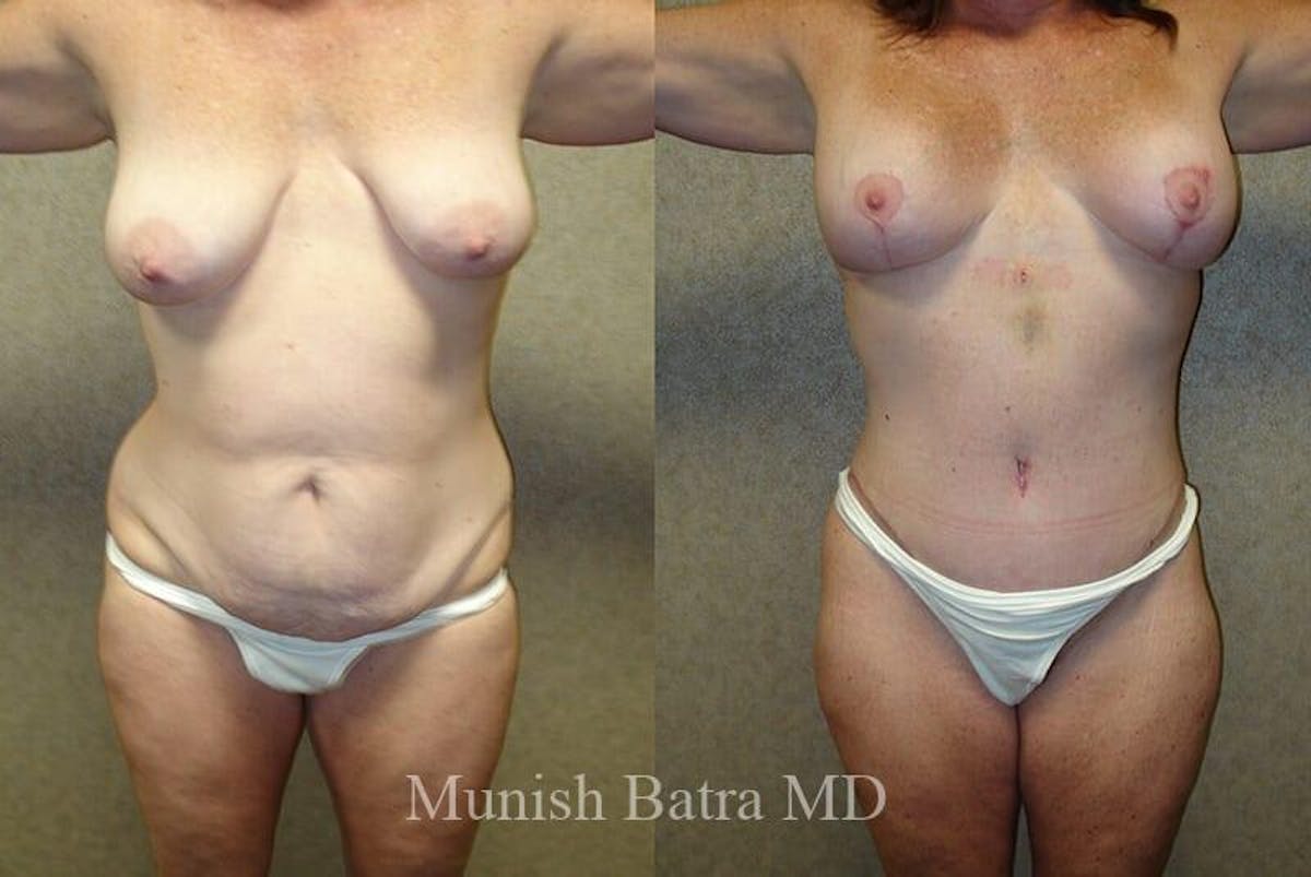 GBRX Abdominoplasty Reconstruction Before & After Gallery - Patient 304412 - Image 1