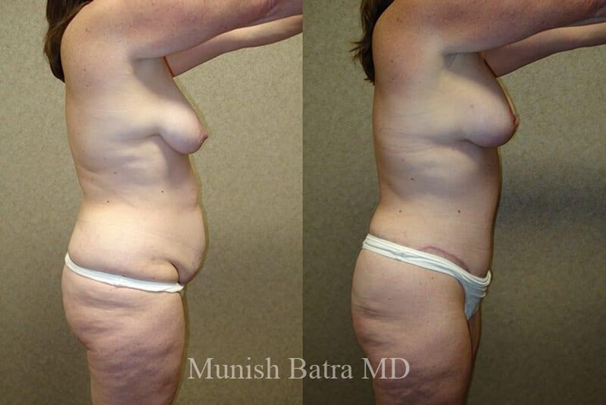 GBRX Abdominoplasty Reconstruction Before & After Gallery - Patient 304412 - Image 2