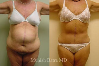GBRX Abdominoplasty Reconstruction Before & After Gallery - Patient 265865 - Image 1