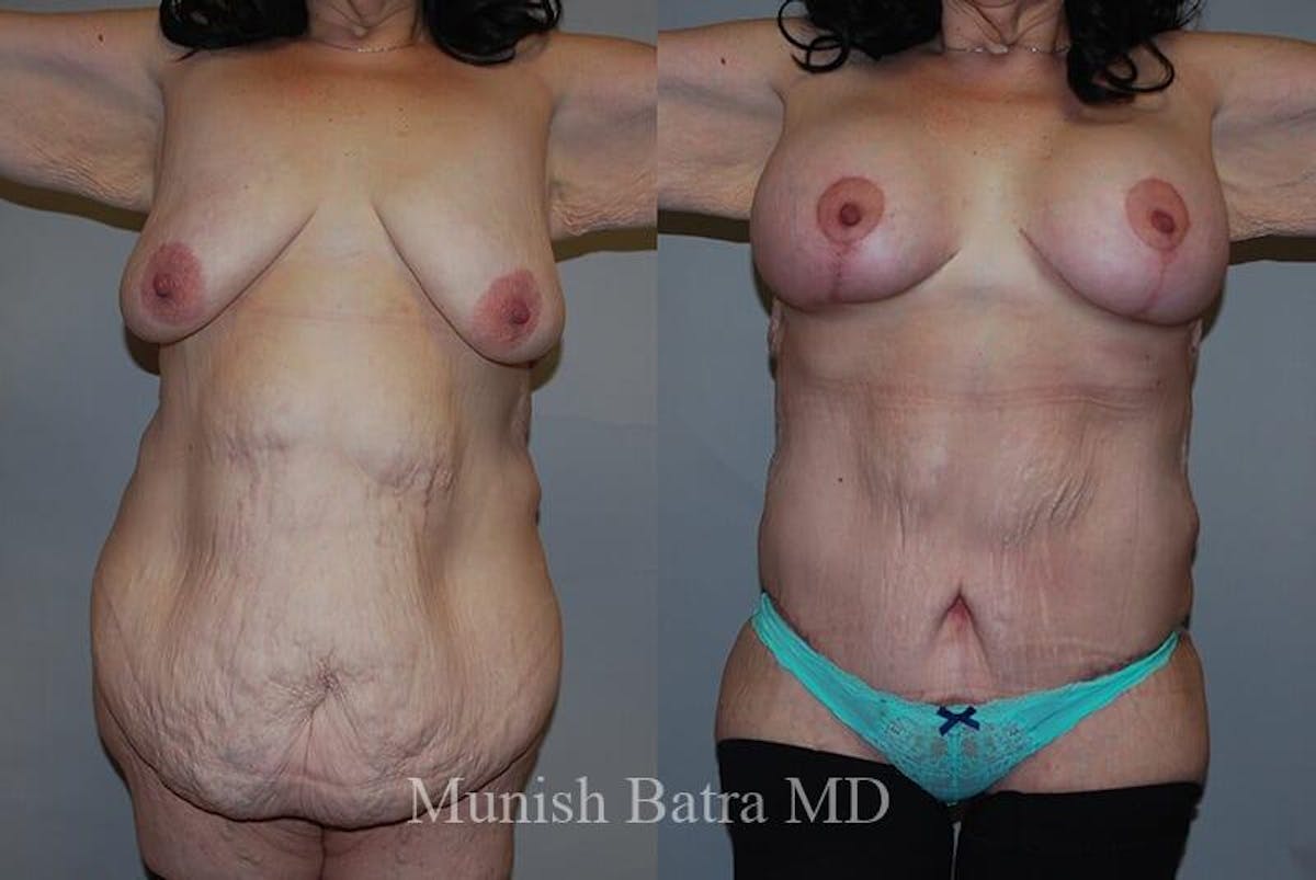 GBRX Abdominoplasty Reconstruction Before & After Gallery - Patient 307284 - Image 1