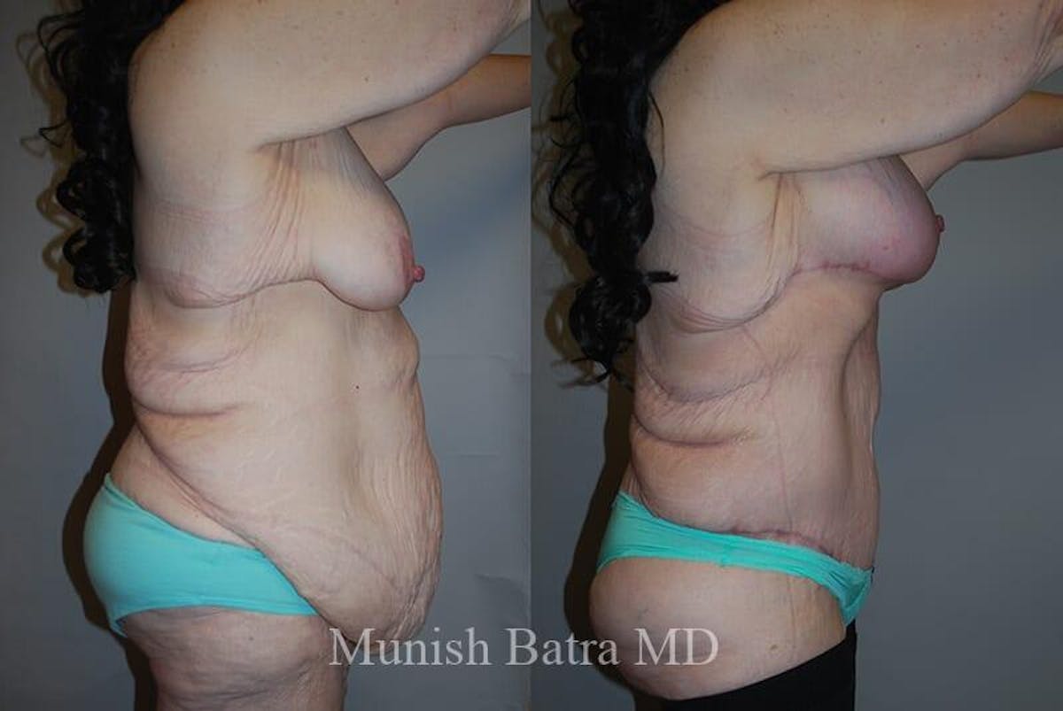 GBRX Abdominoplasty Reconstruction Before & After Gallery - Patient 307284 - Image 2