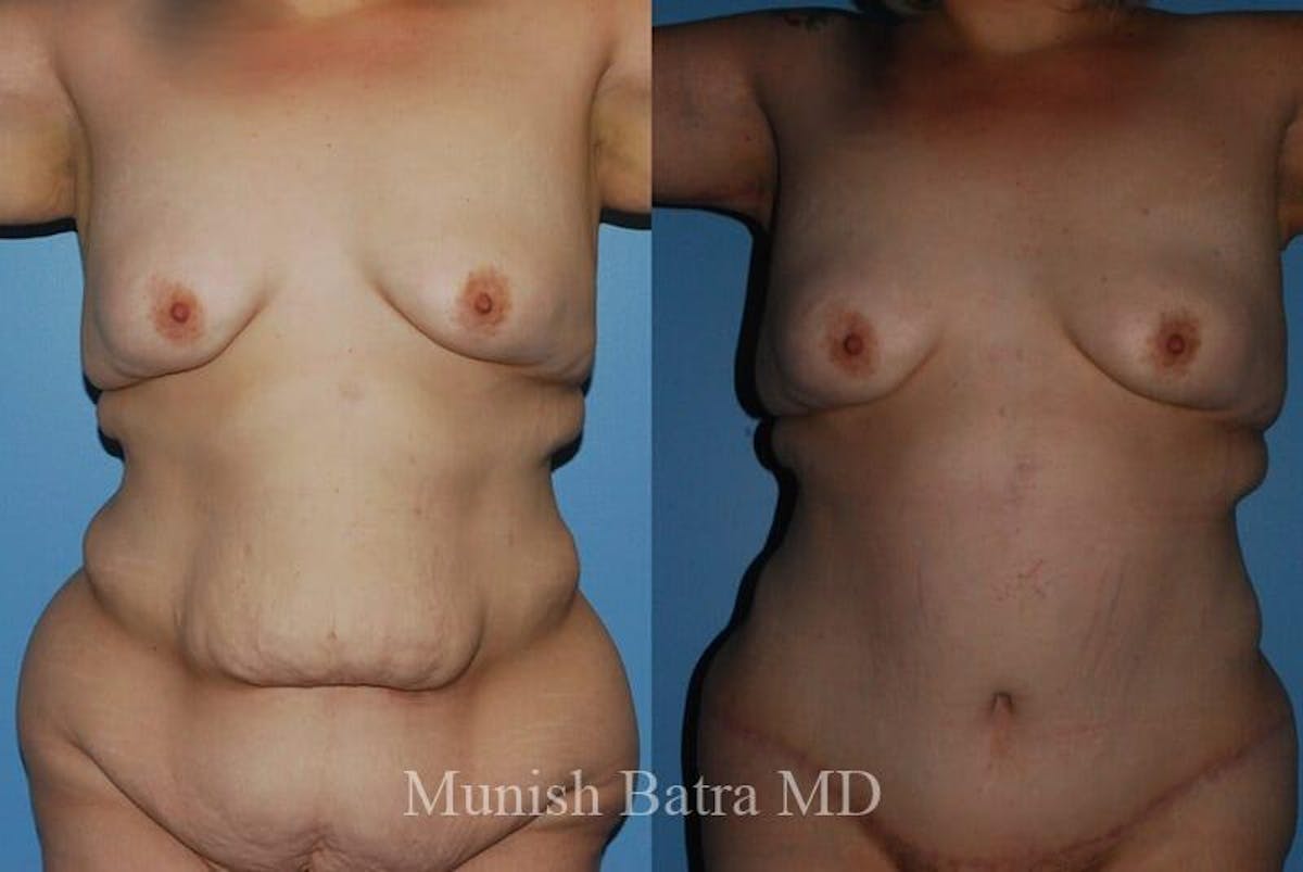 GBRX Abdominoplasty Reconstruction Before & After Gallery - Patient 193075 - Image 1