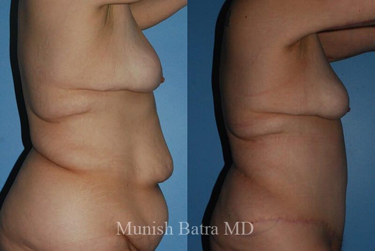 GBRX Abdominoplasty Reconstruction Before & After Gallery - Patient 193075 - Image 2