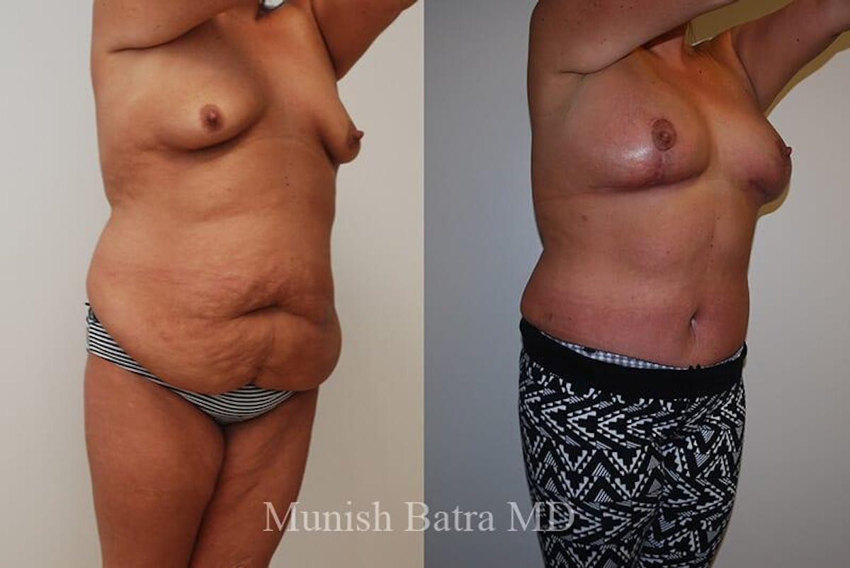 GBRX Abdominoplasty Reconstruction Before & After Gallery - Patient 218412 - Image 1