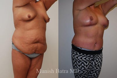 GBRX Abdominoplasty Reconstruction Before & After Gallery - Patient 218412 - Image 1