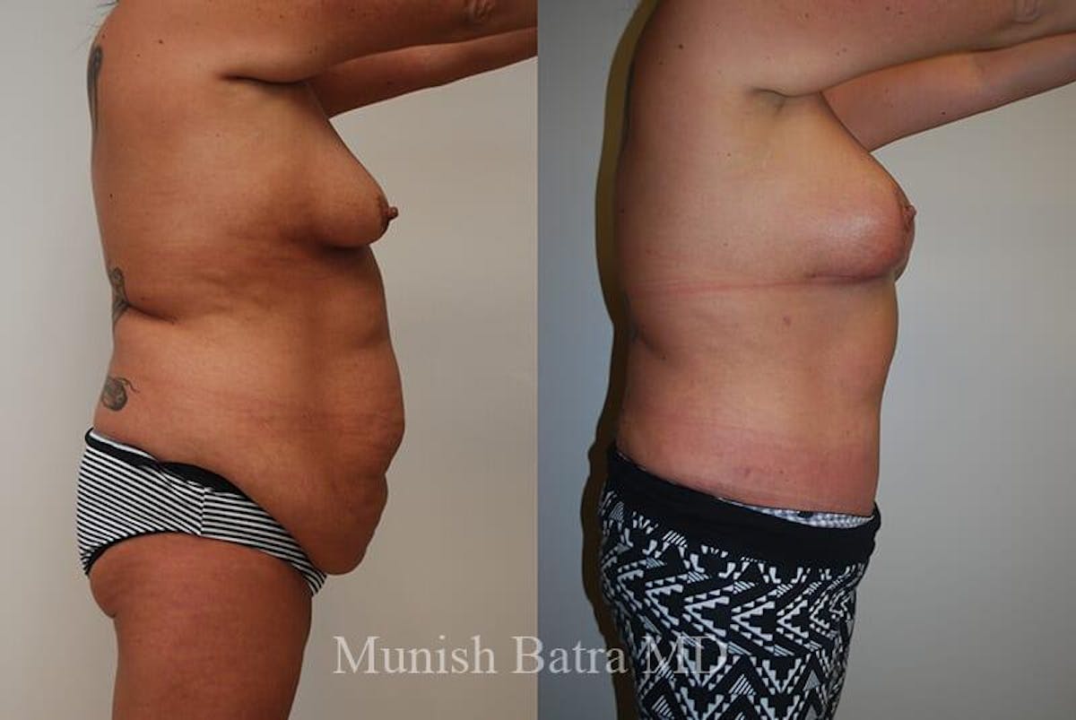 GBRX Abdominoplasty Reconstruction Before & After Gallery - Patient 218412 - Image 2