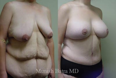 GBRX Abdominoplasty Reconstruction Before & After Gallery - Patient 151207 - Image 1