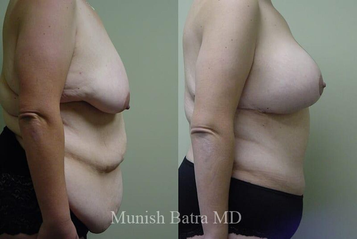 GBRX Abdominoplasty Reconstruction Before & After Gallery - Patient 151207 - Image 2