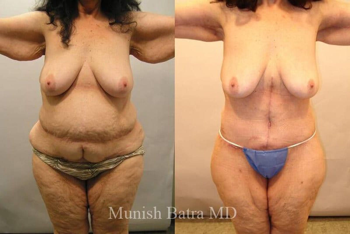 GBRX Abdominoplasty Reconstruction Before & After Gallery - Patient 200940 - Image 1