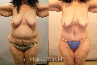 GBRX Abdominoplasty Reconstruction Before & After Gallery - Patient 200940 - Image 1