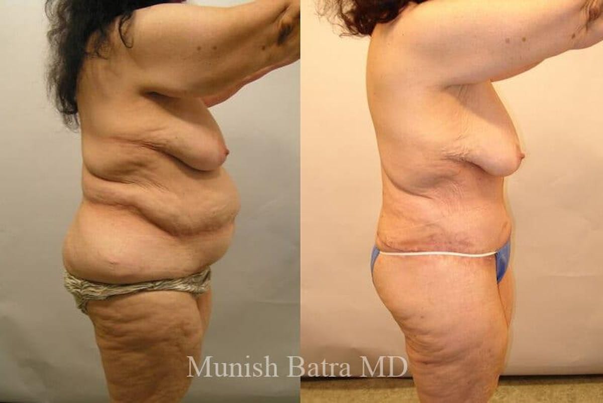 GBRX Abdominoplasty Reconstruction Before & After Gallery - Patient 200940 - Image 2