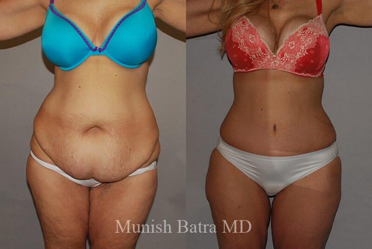 GBRX Abdominoplasty Reconstruction Before & After Gallery - Patient 420438 - Image 1