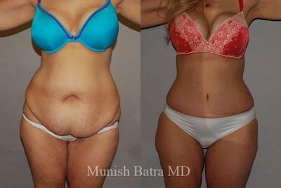 GBRX Abdominoplasty Reconstruction Before & After Gallery - Patient 420438 - Image 1