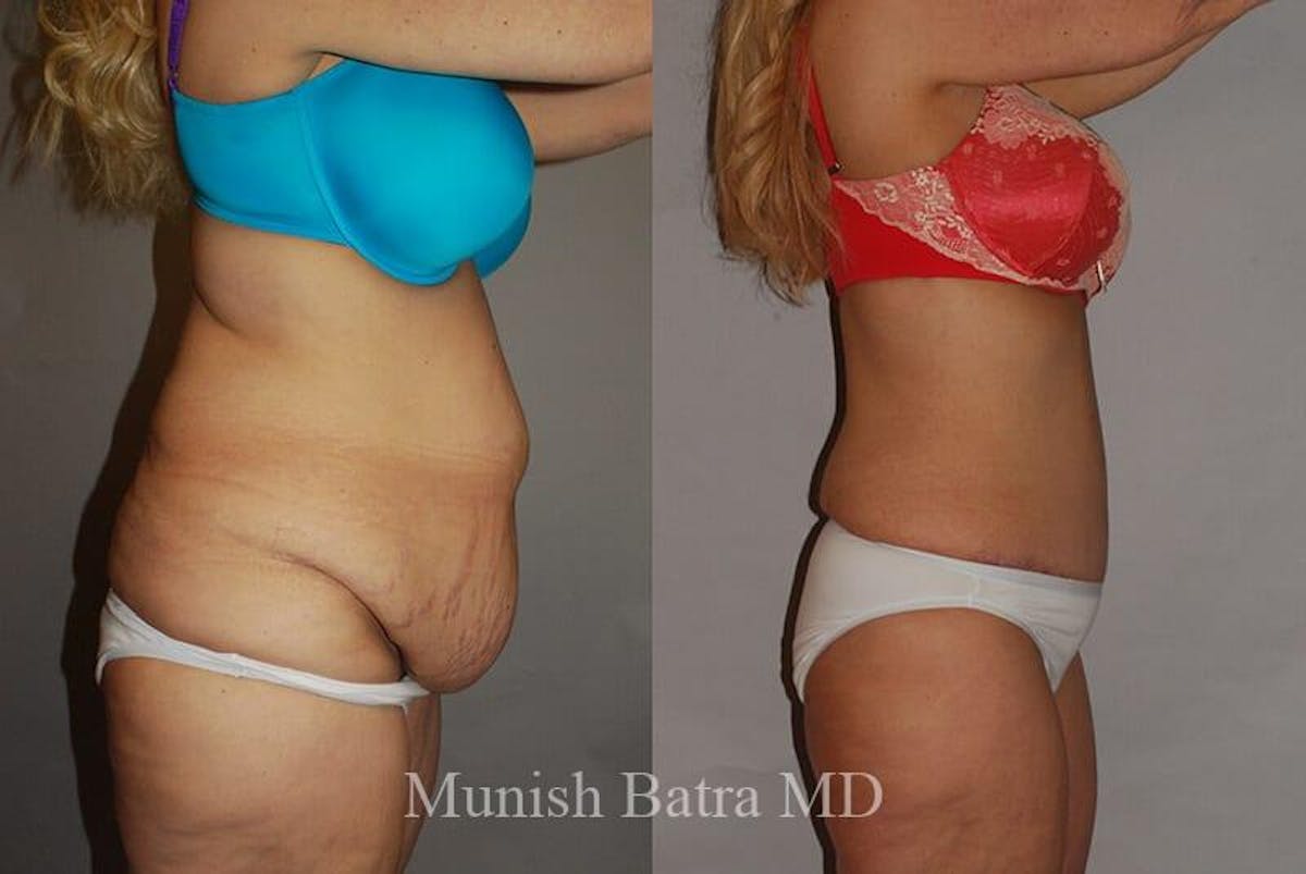GBRX Abdominoplasty Reconstruction Before & After Gallery - Patient 420438 - Image 2
