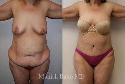 GBRX Abdominoplasty Reconstruction Before & After Gallery - Patient 282033 - Image 1