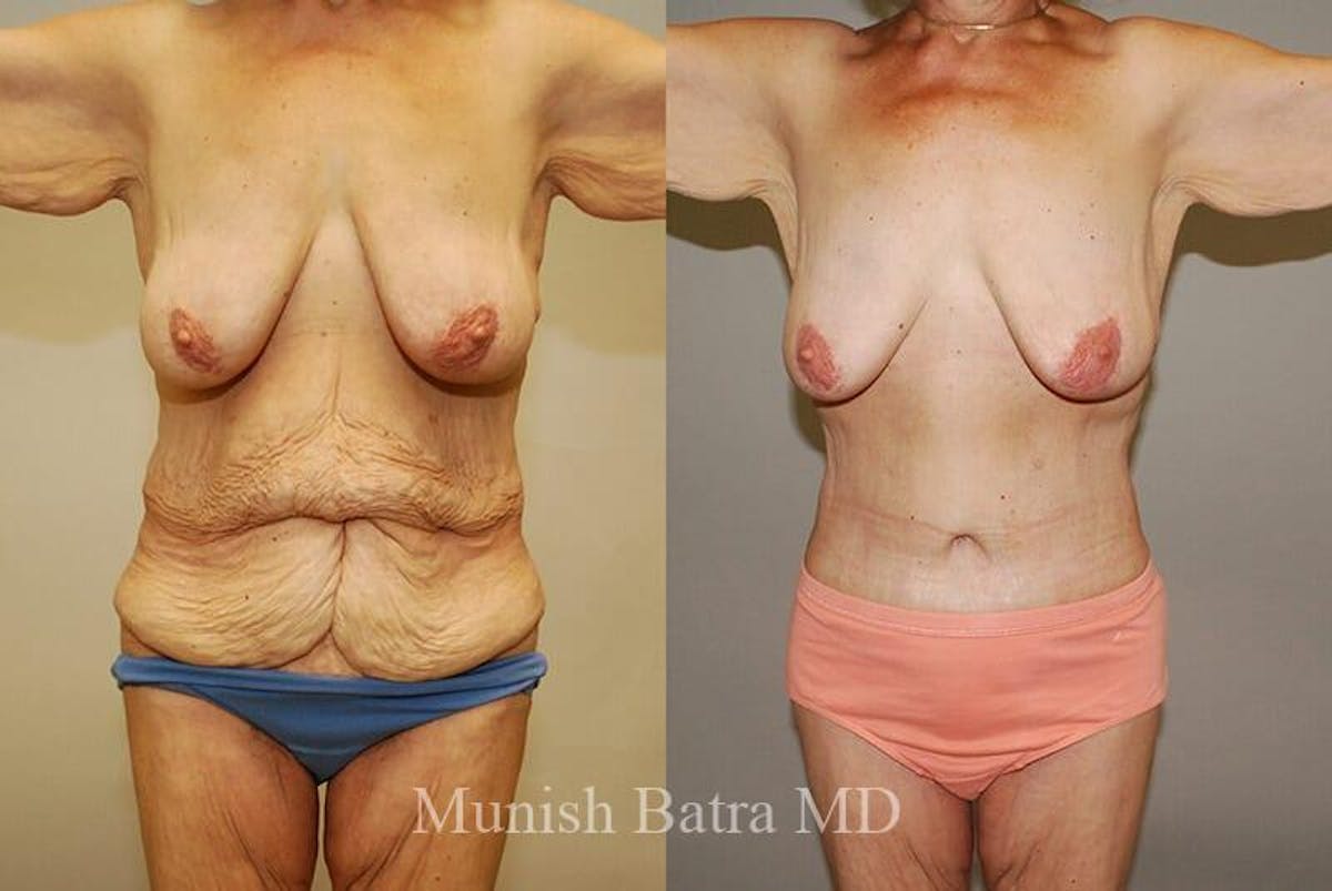 GBRX Abdominoplasty Reconstruction Before & After Gallery - Patient 265390 - Image 1