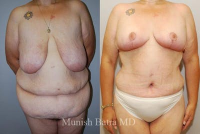 GBRX Abdominoplasty Reconstruction Before & After Gallery - Patient 307536 - Image 1