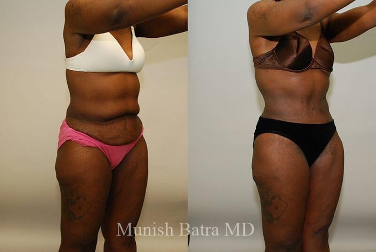 GBRX Abdominoplasty Reconstruction Before & After Gallery - Patient 270533 - Image 1