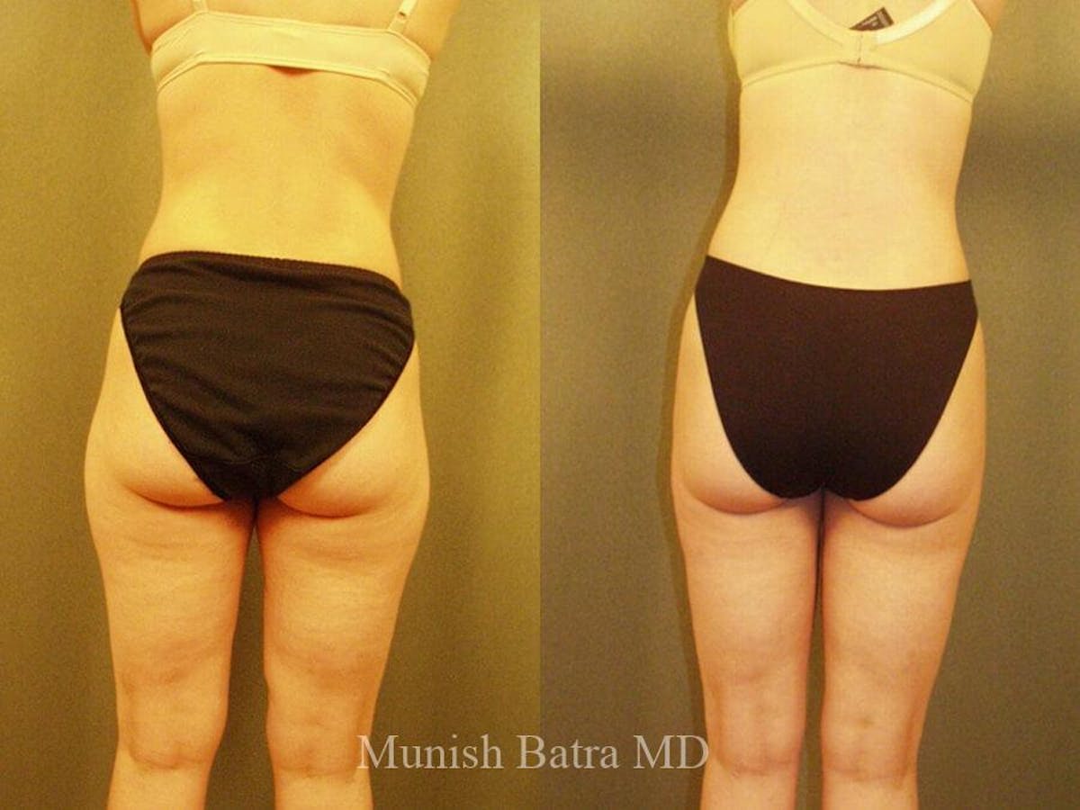 Liposuction & Body Contouring Before & After Gallery - Patient 916806 - Image 1