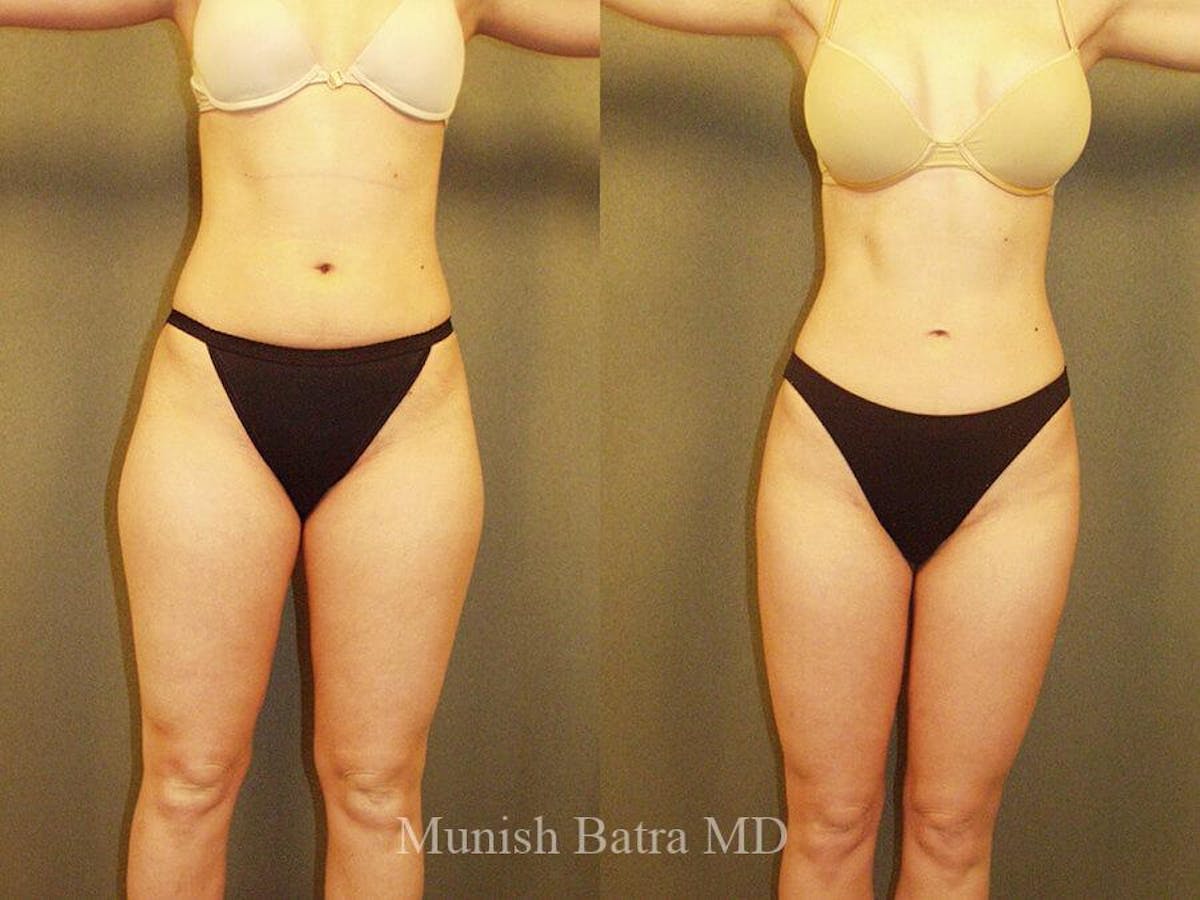 Liposuction & Body Contouring Before & After Gallery - Patient 916806 - Image 2