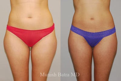 Liposuction & Body Contouring Before & After Gallery - Patient 174839 - Image 1