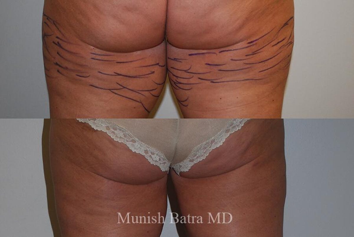Liposuction & Body Contouring Before & After Gallery - Patient 483385 - Image 1